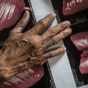 Laudos provam que médicos pagos por Mineradora da Eternit, abafaram mortes por&nbsp;amianto